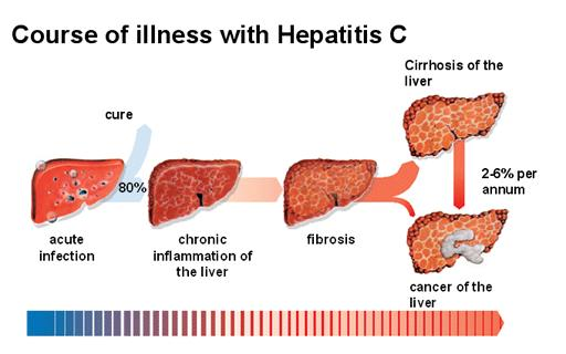 Hepatitis C Virus - Microbiology - Medbullets Step 1